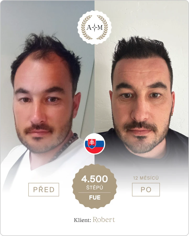 Foto před a po transplantaci vlasů