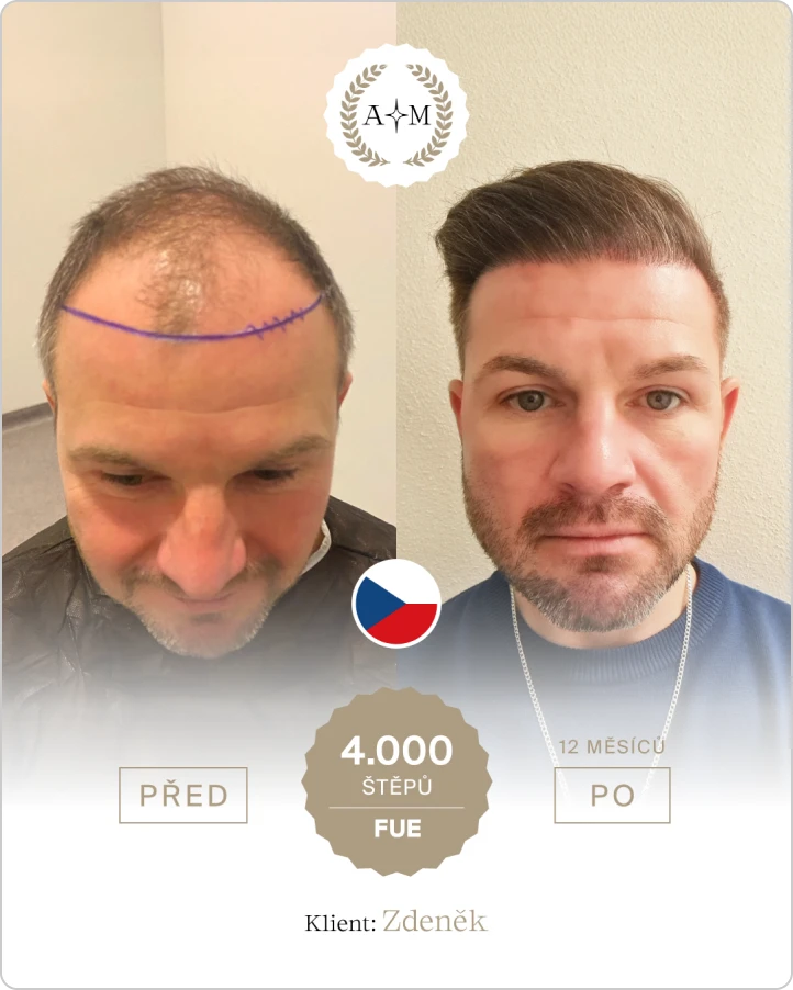 Foto před a po transplantaci vlasů
