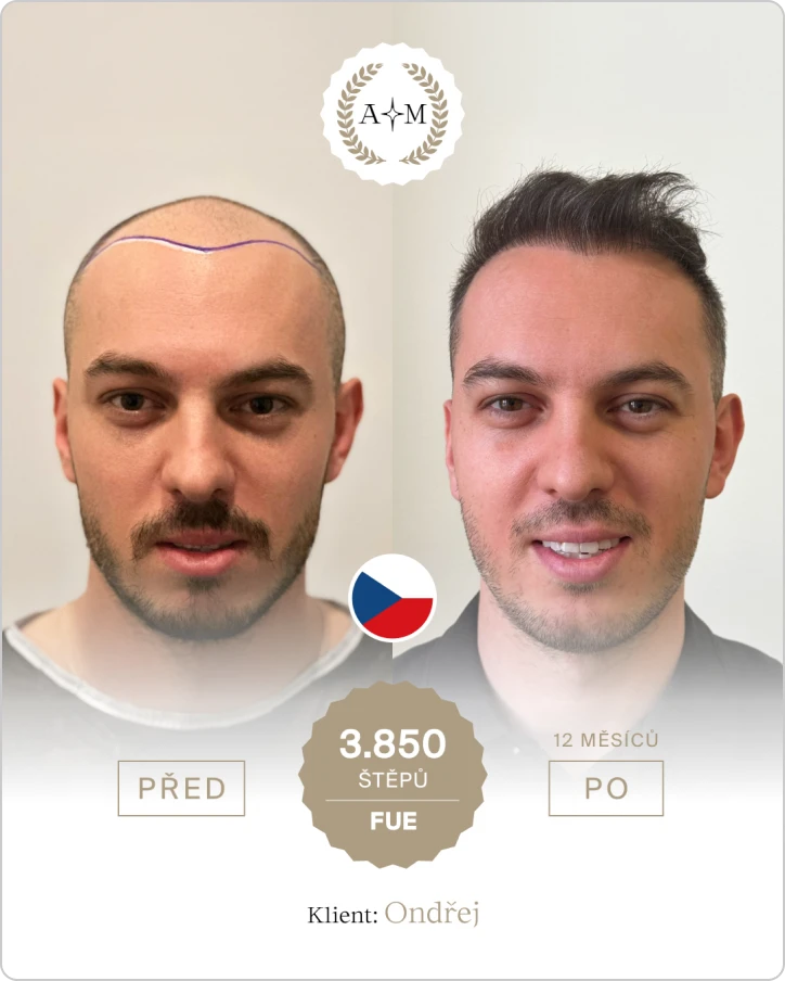 Foto před a po transplantaci vlasů