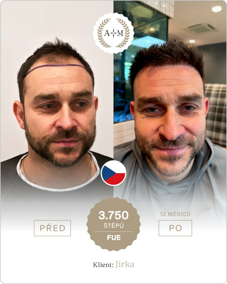 Foto před a po transplantaci vlasů